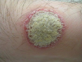 皮炎性湿疹和银屑病有什么不同